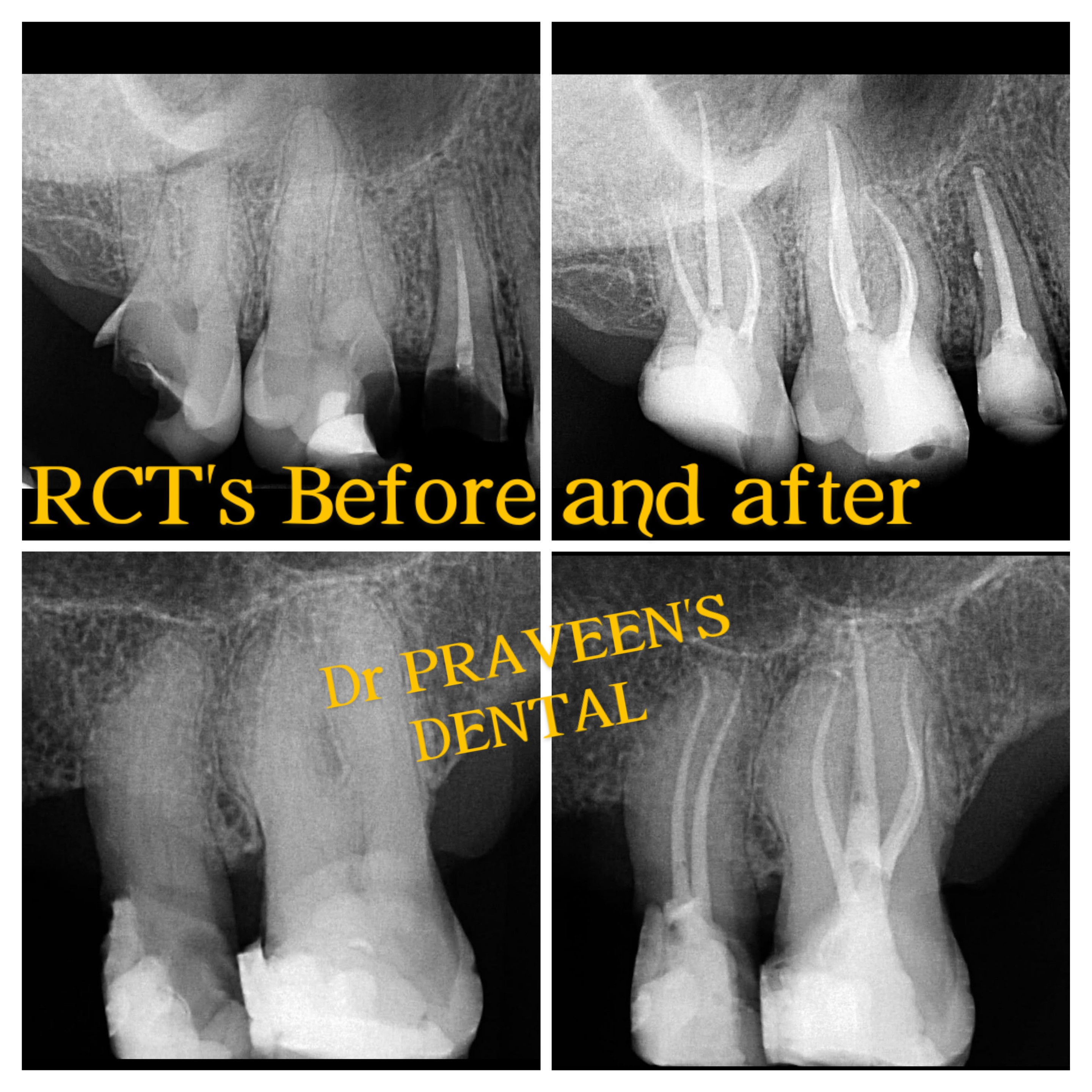 After Root Canal