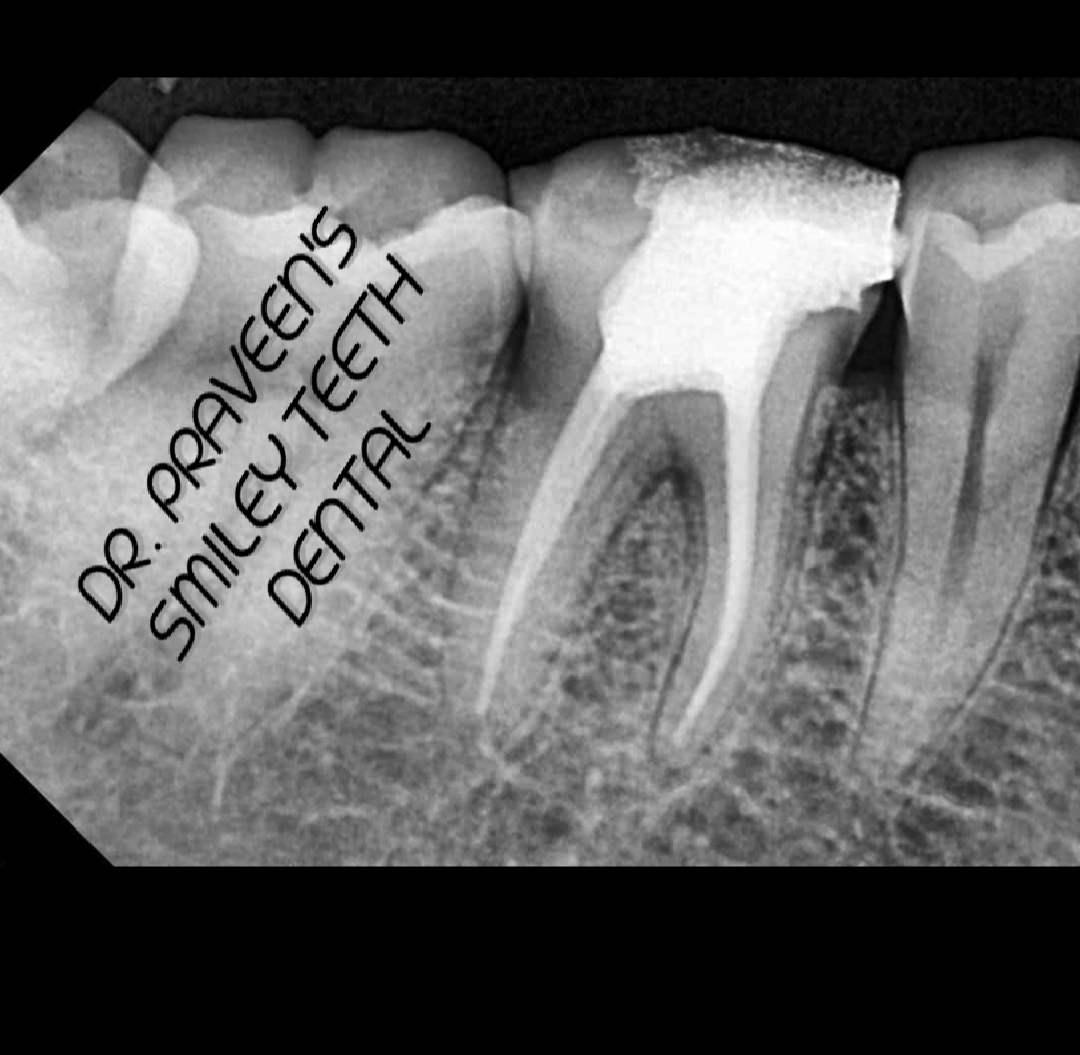 Advanced endodontic equipment