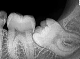 Wisdom teeth X-ray